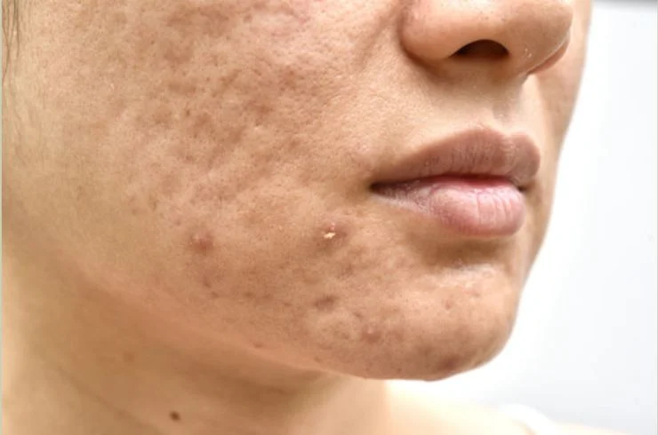 Acne Scar Laser Treatment