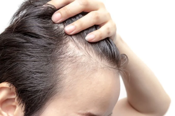 Alopecia (Hair Loss) Treatment