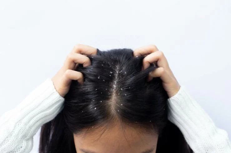 Dandruff Treatment