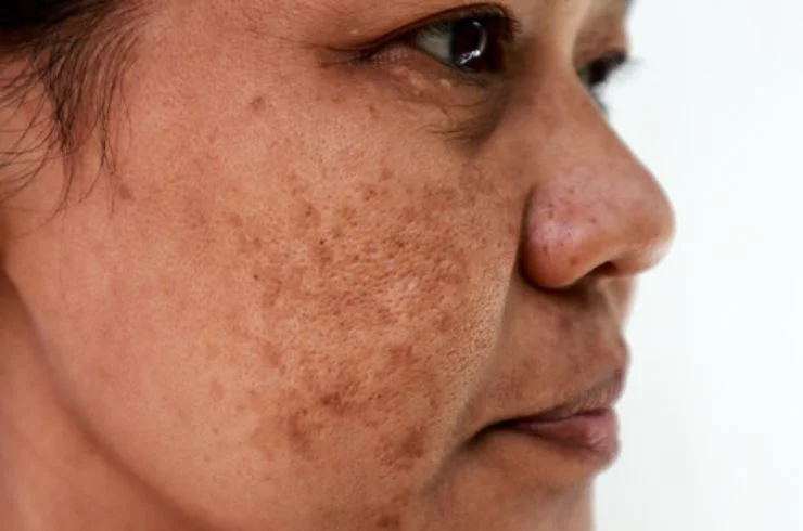 Melasma Treatment